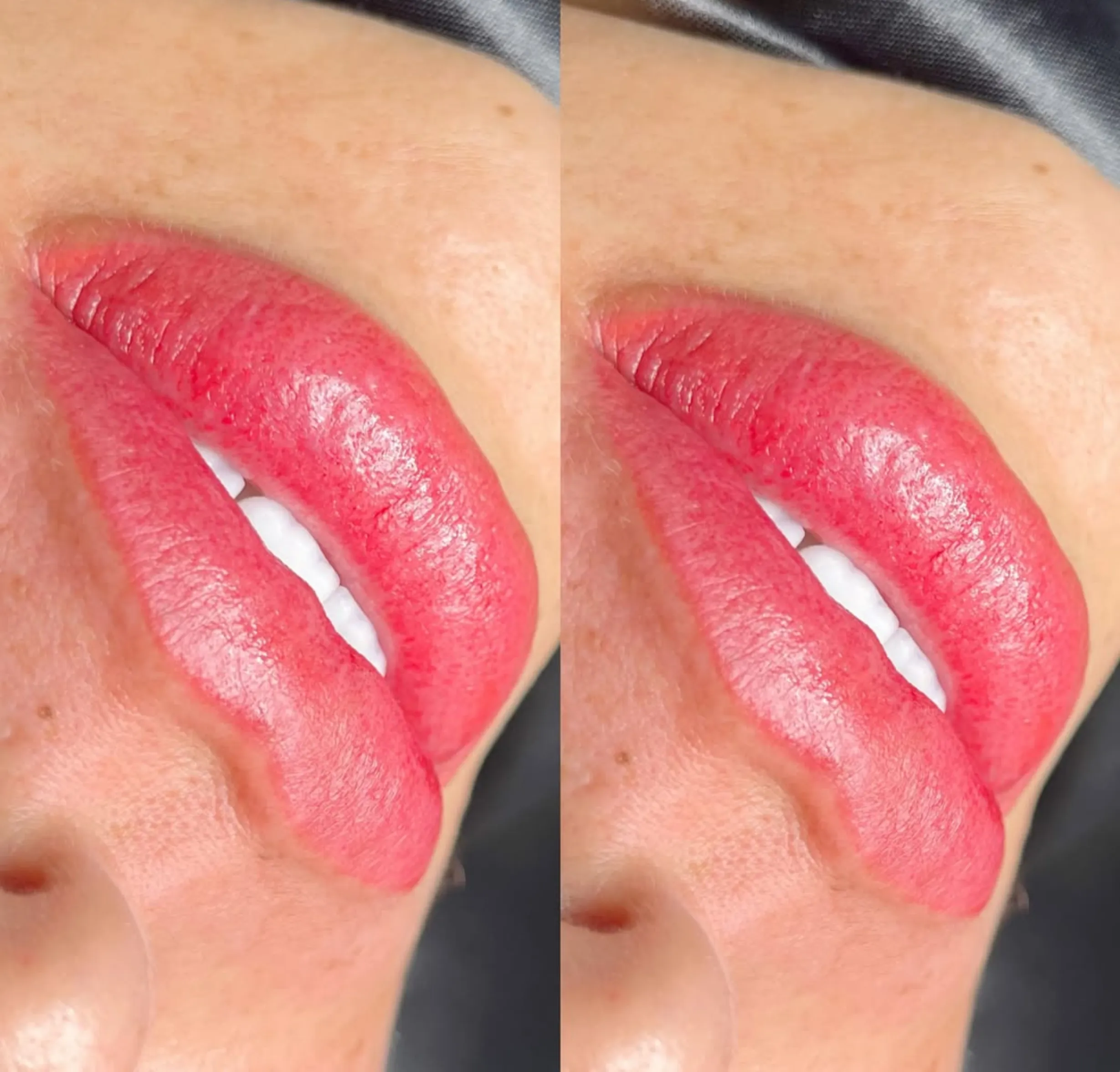 bruising after lip tattoo