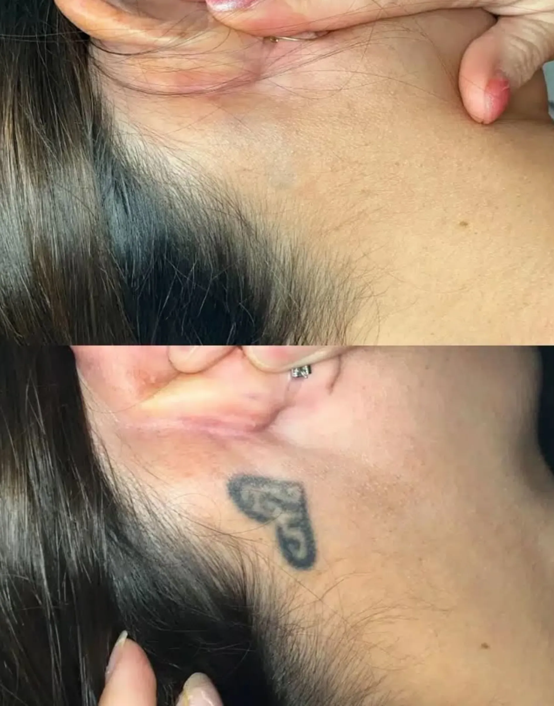 home tattoo removal risks
