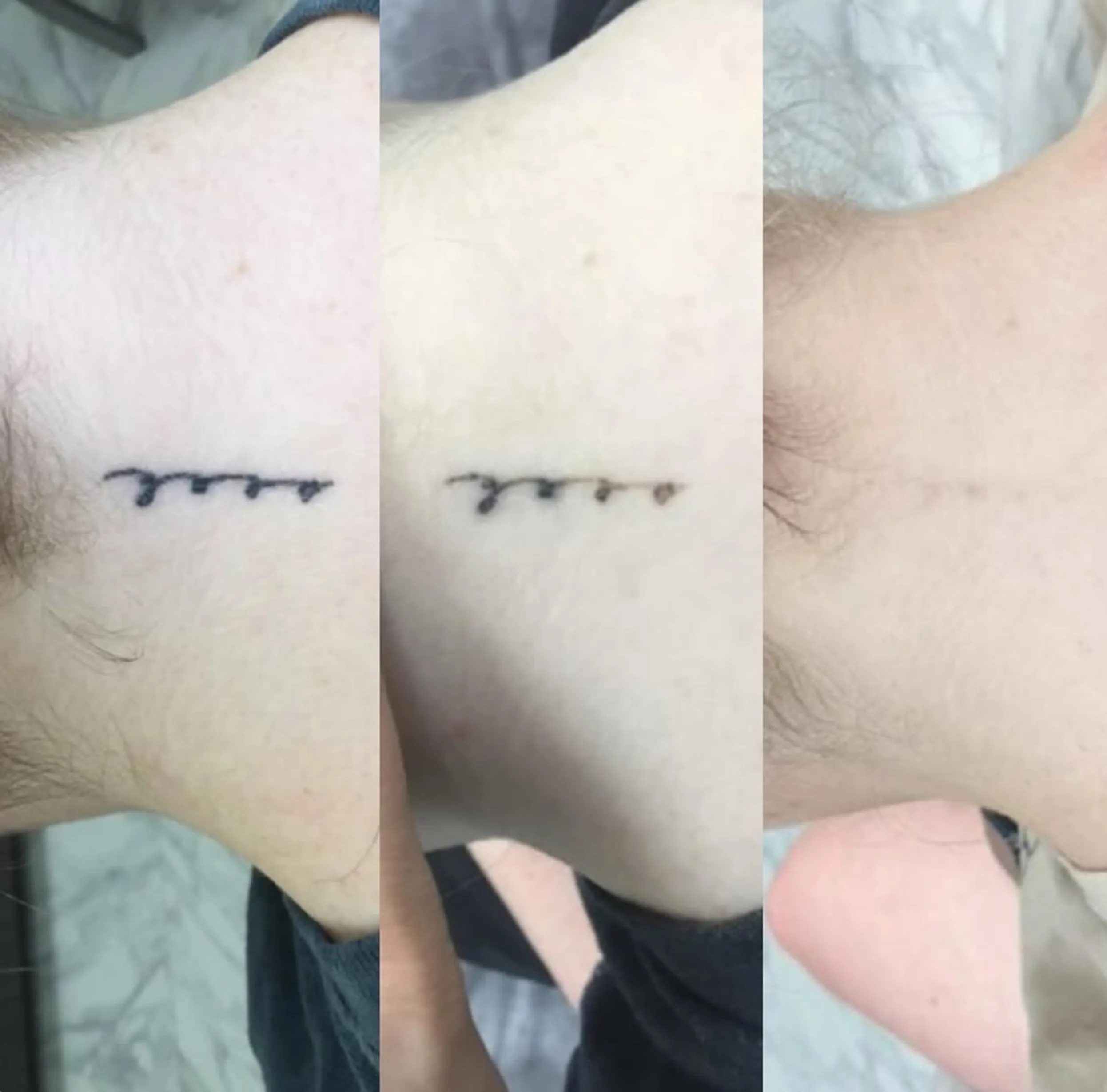 saline vs laser tattoo removal