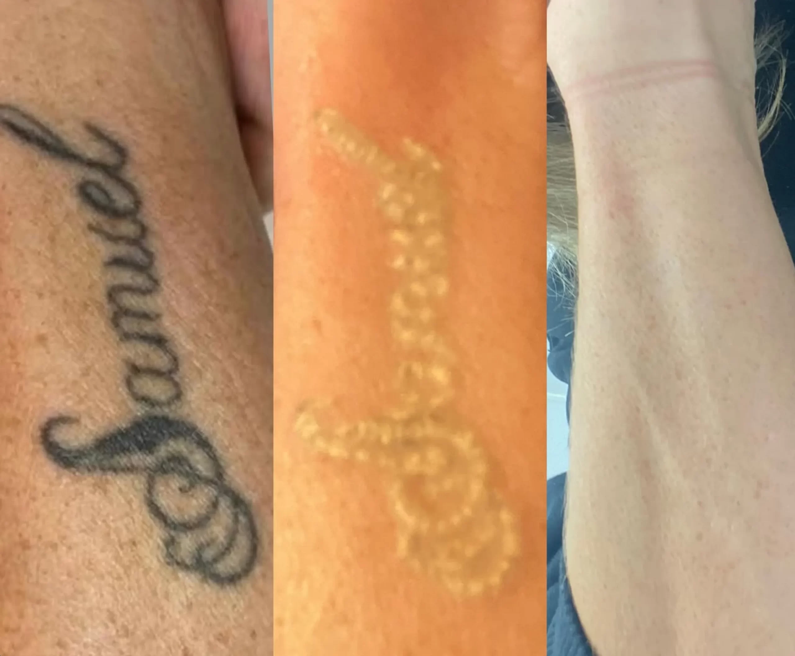 eyebrow tattoo removal price