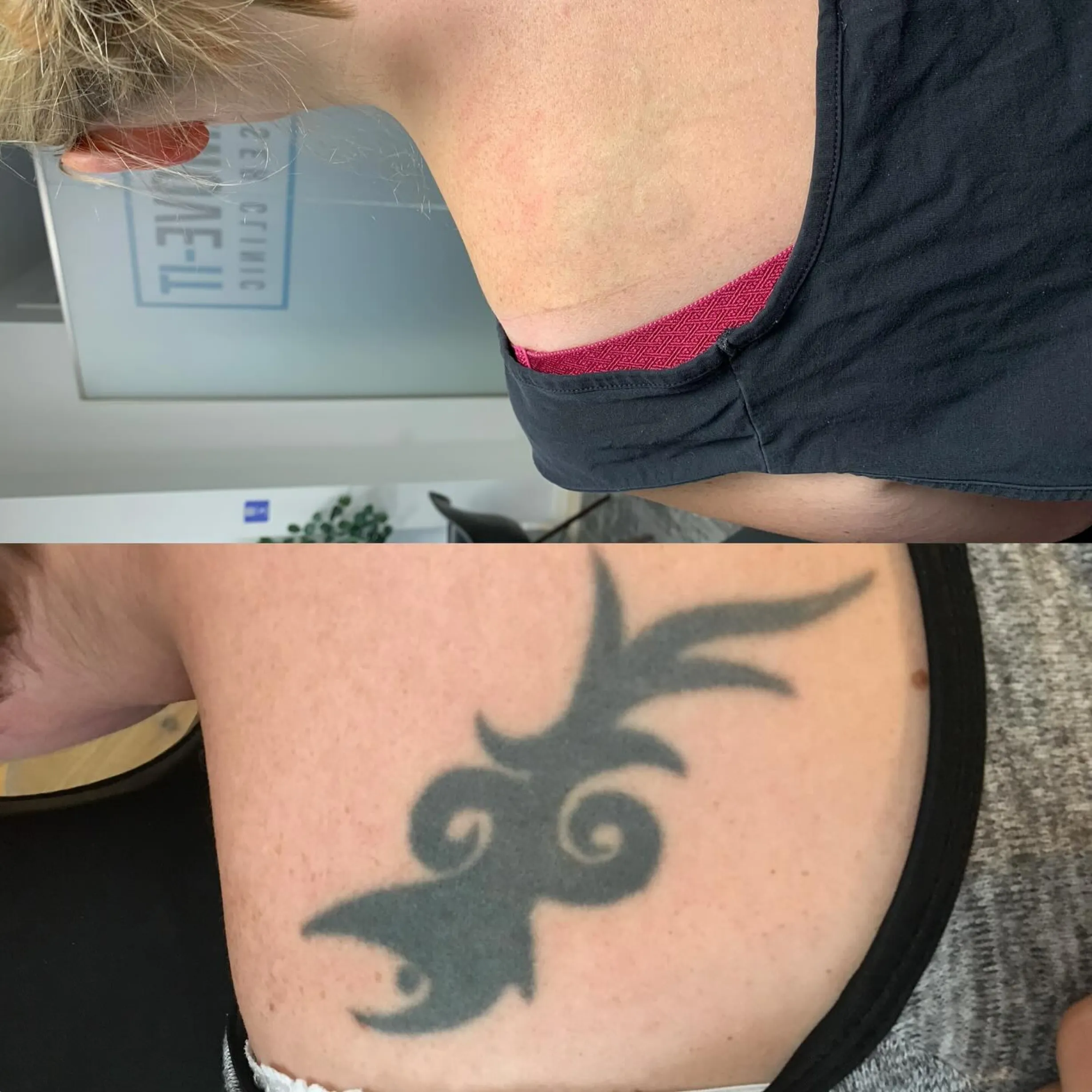 laser tattoo removal cost Brisbane